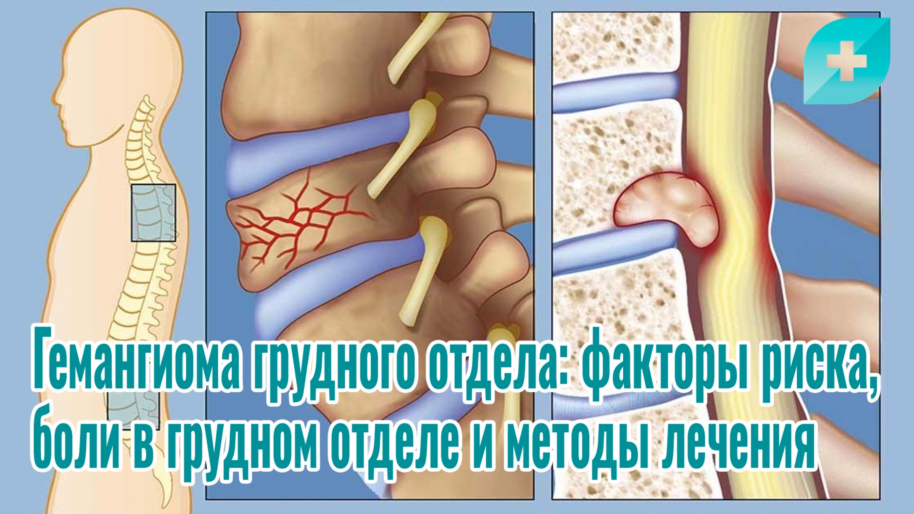 Гемангиома грудного отдела: факторы риска, боли в грудном отделе и методы лечения