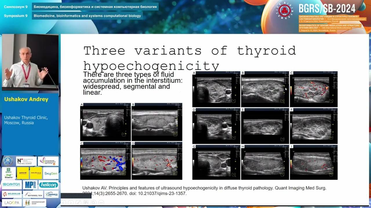 Ushakov AV Pathogenesis of thyroid stromal swelling || BGRS/SB-2024