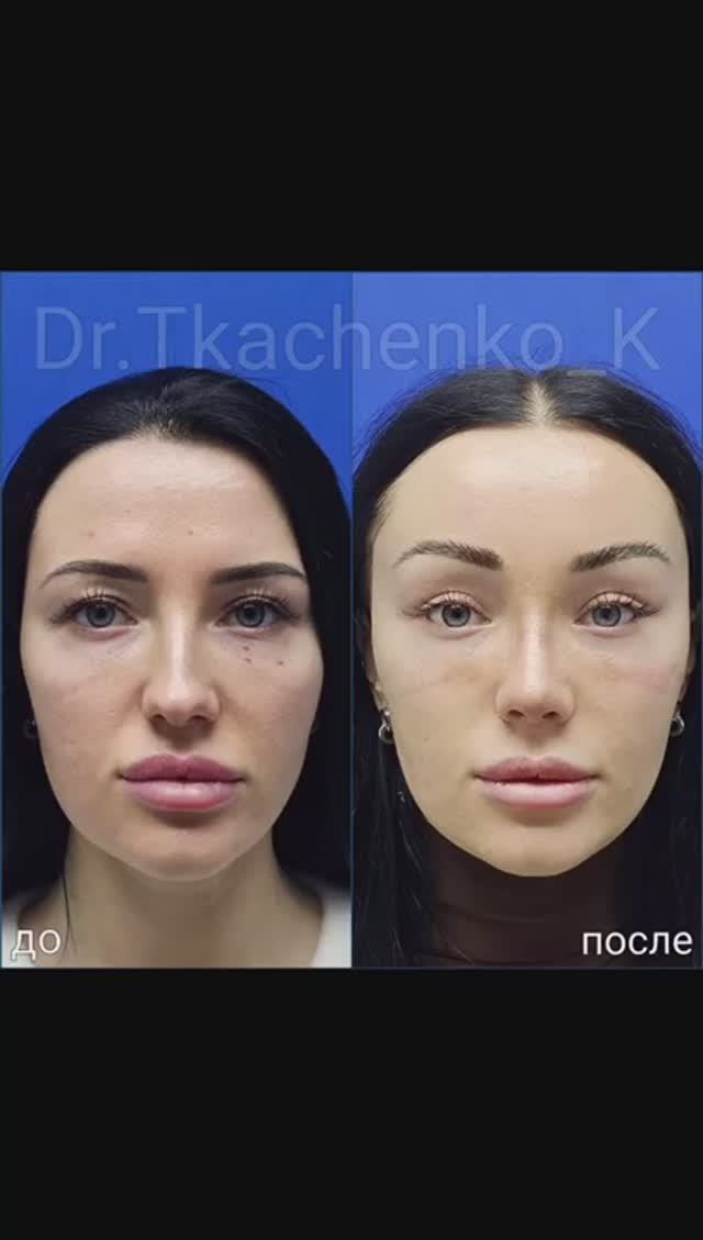 Эндоскопическая подтяжка лба и ринопластика.
Ранний результат 12 дней .