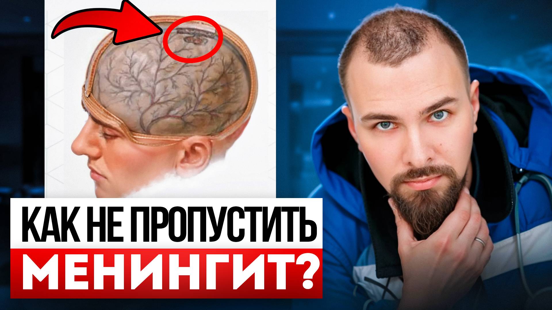 Как не пропустить МЕНИНГИТ? Кто его вызывает на самом деле?