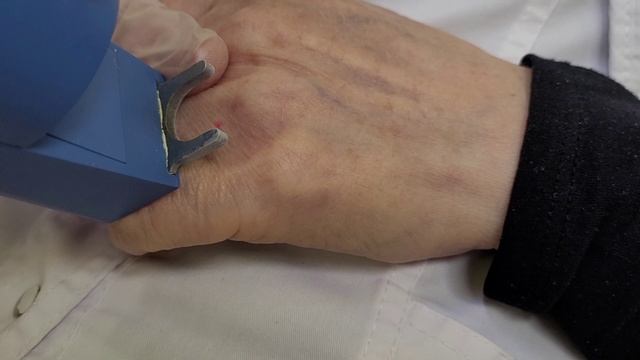 Лазерное удаление ангиомы на кисти