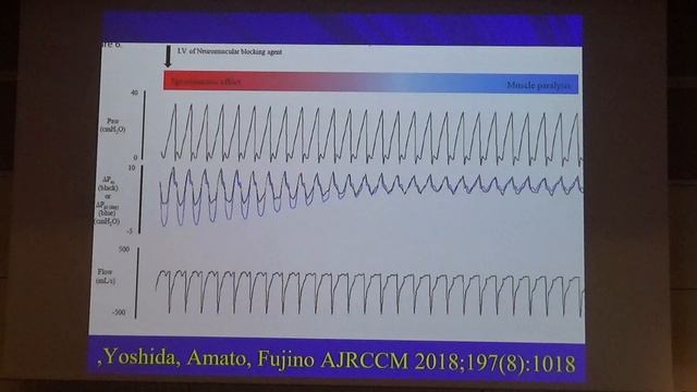 Which asynchronies have the greatest potential for causing injury  Robert M Kacmarek