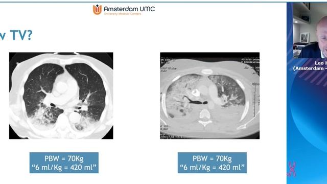 Controlled ventilation in ARDS volume or pressure Leo Heunks 2021