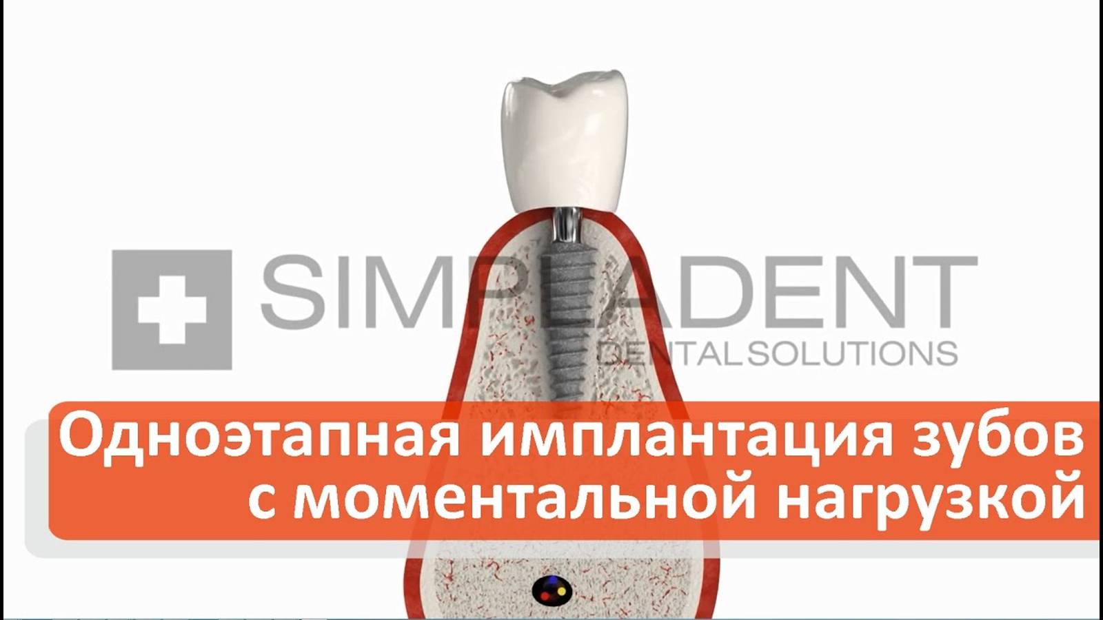 Одноэтапная имплантация зубов с моментальной нагрузкой. Simpladent. Симпладент.