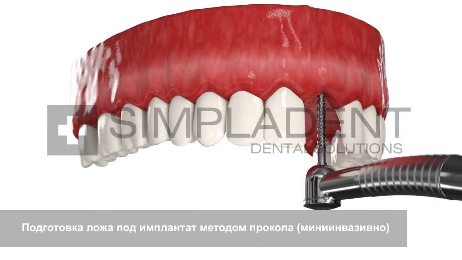 Как происходит имплантация переднего зуба. Simpladent Симпладент