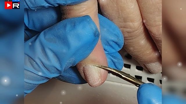 Восстановление ногтей Укрепляем ногти🙋 Скрываем деформированный ноготь👍#убитыеногти#правскаямария