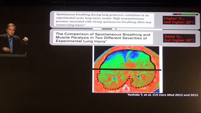 Spontaneous breathing in ARDS We should estimate muscle driving pressure Marcelo Amato