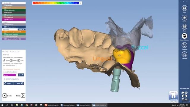 Truabutment tibase workflow with Planmeca and exocad