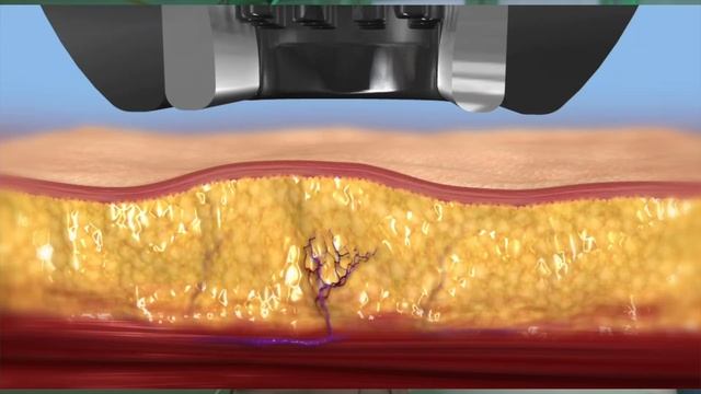 Безоперационная липосакция Body FX в Медицинском центре "Биомоджо"