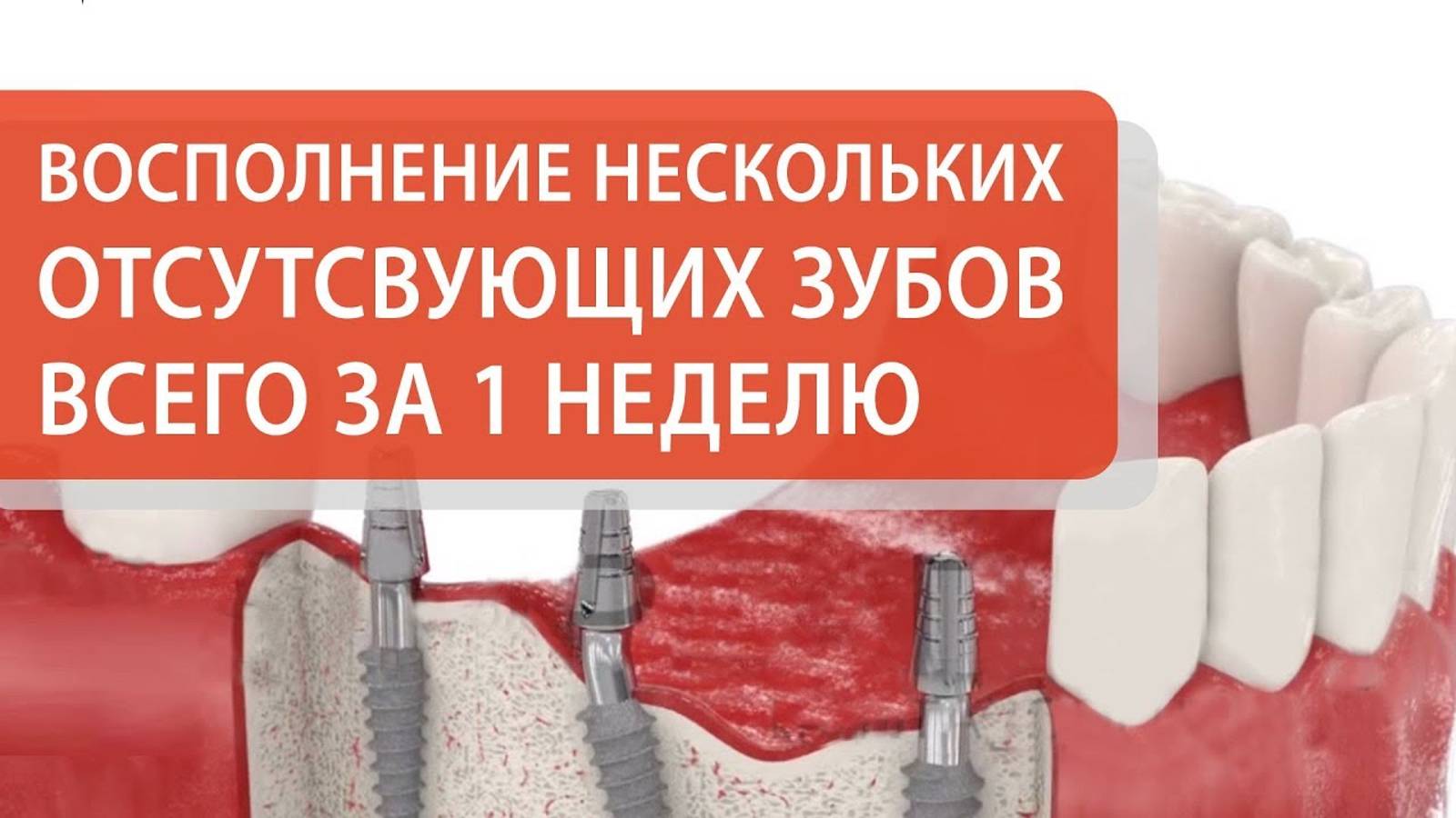 Как восполняют несколько отсутствующих зубов за 1 неделю👌Пример операции в 3D. 12+