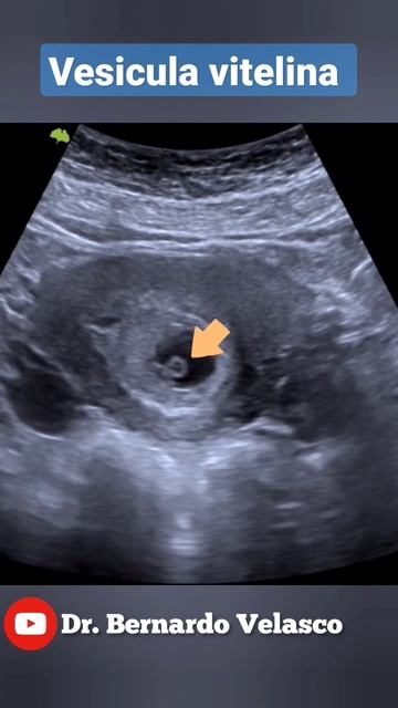 VESICULA VITELINA EMBARAZO DE 6 SEMANAS DE GESTACIÓN