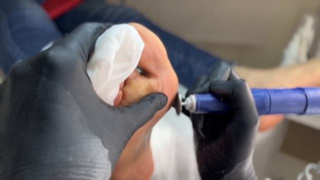 Применение пилинга в педикюре для восстановлени кожи. Заменяет все виды кератолитиков.
