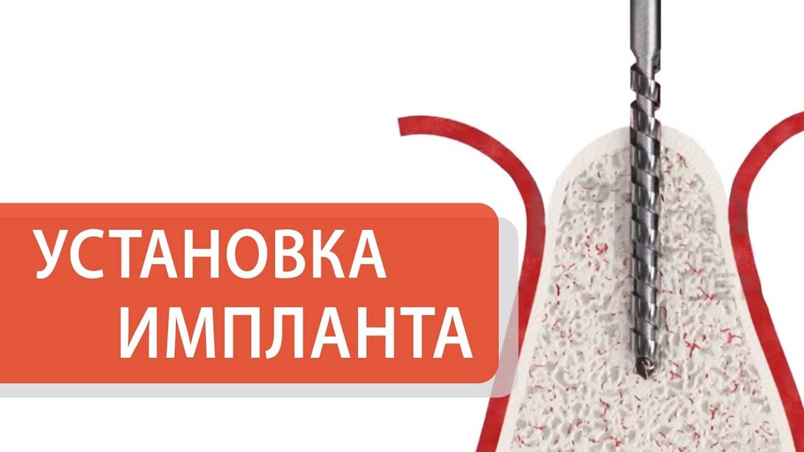 Как устанавливают зубные импланты. 👄 Подробно о том, как происходит  установка зубного импланта. 12+