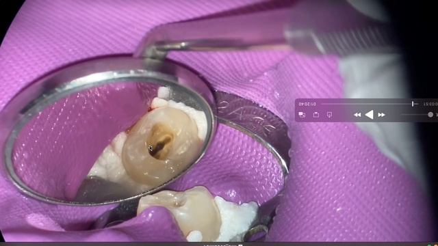 #1 Buccal Restoration Tip -  Trust me, it's simple.