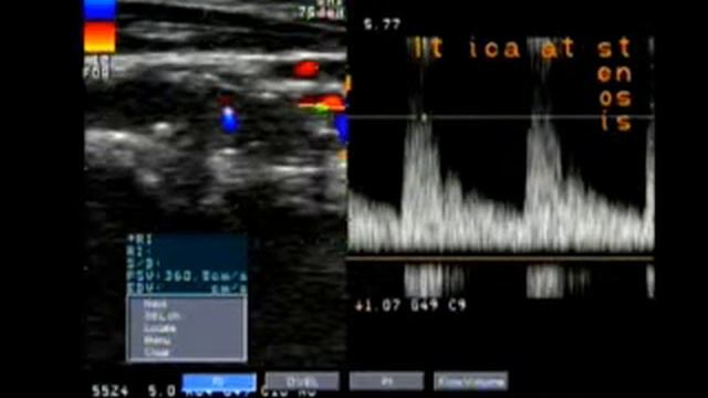 Doppler Carotid  internal carotid artery more than 80%  stenosis