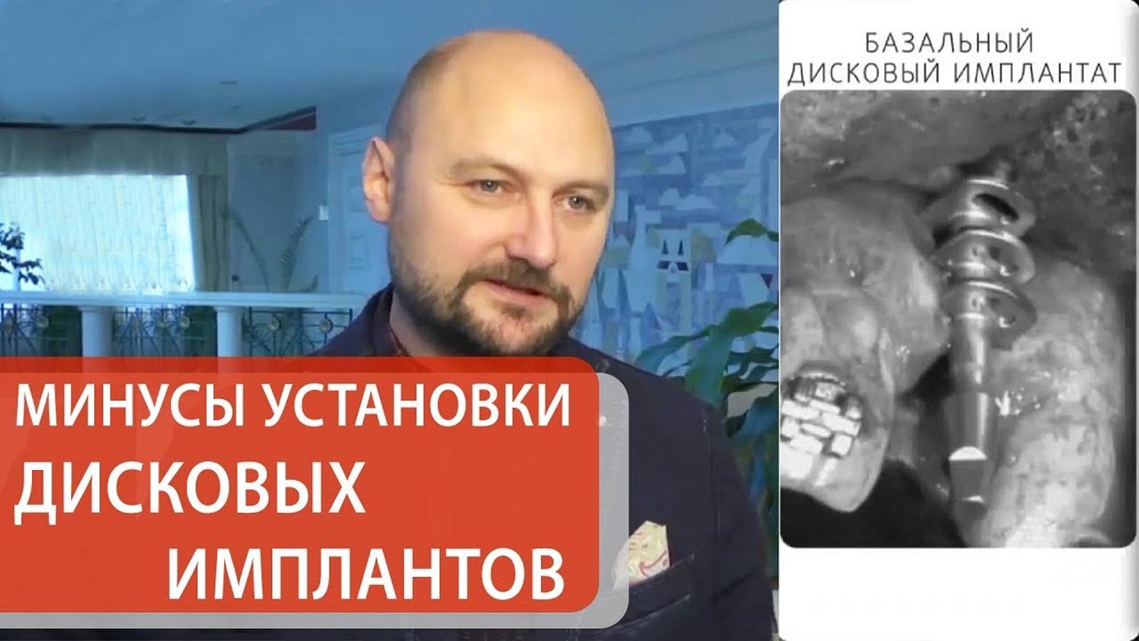 Стоматологи о тонкостях проведения базальной имплантации. Установка зубных имплантов. Симпладент.12+