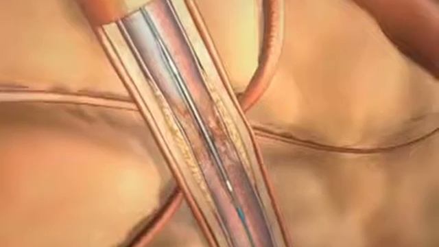 Carotid Artery Disease Medical Animation