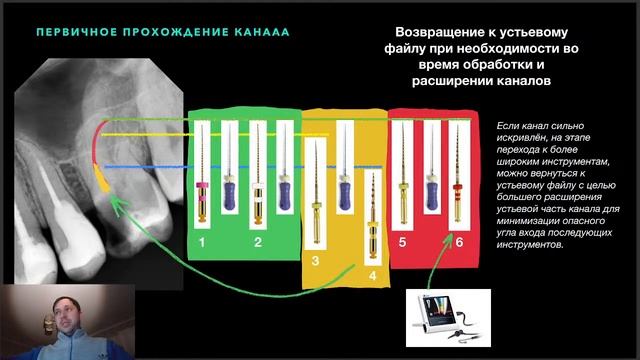 ПЕРВИЧНАЯ ОБРАБОТКА КАНАЛОВ МОЛЯРА БЕЗ КОВРОВОЙ ДОРОЖКИ , МАШИННЫМИ ФАЙЛАМИ SOCO