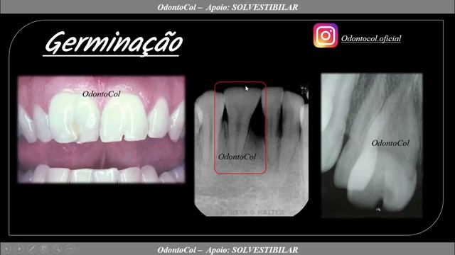 ANOMALIAS DENTÁRIAS : PATOLOGIA BUCAL