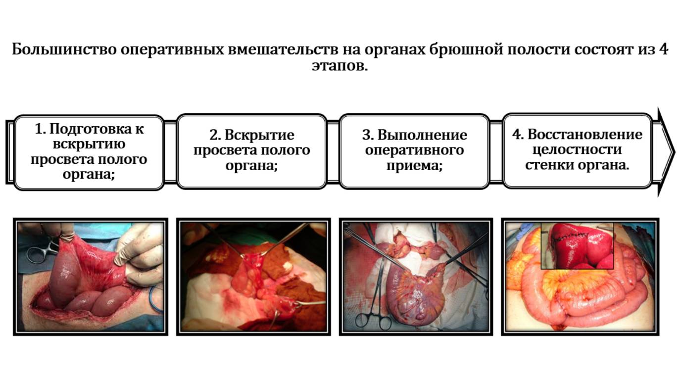 Брюшная полость - топографическая анатомия. Основы кишечного шва. Межкишечные анастомозы.