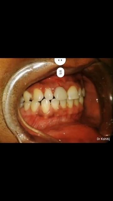 socket shield and immidiate loading with traumatic fracture maxillary right central incisor .