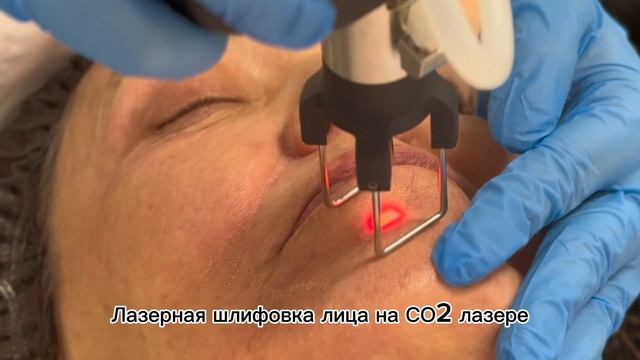 Лазерная шлифовка на СО2 лазере