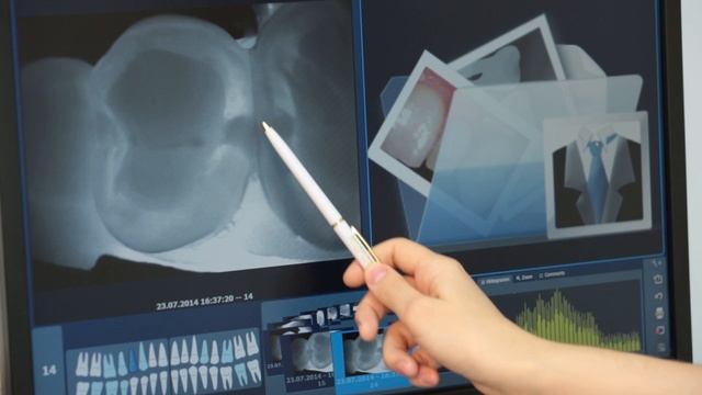 Диагностика скрытых форм кариеса при помощи ＂DiagnoCam＂