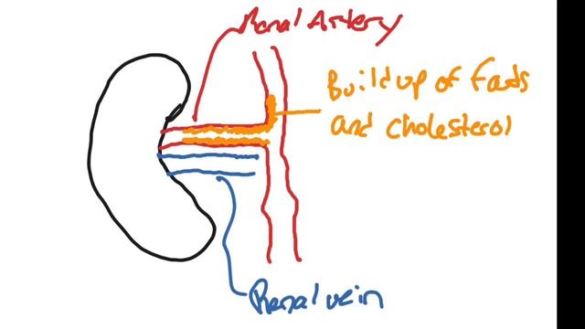 Renal Artery Stenosis