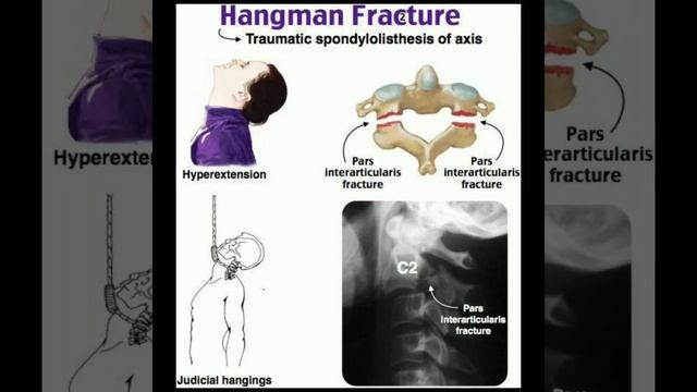 Hangman fracture Traumatic Spondylolisthesis of axis #doctor #shortsfeed #short