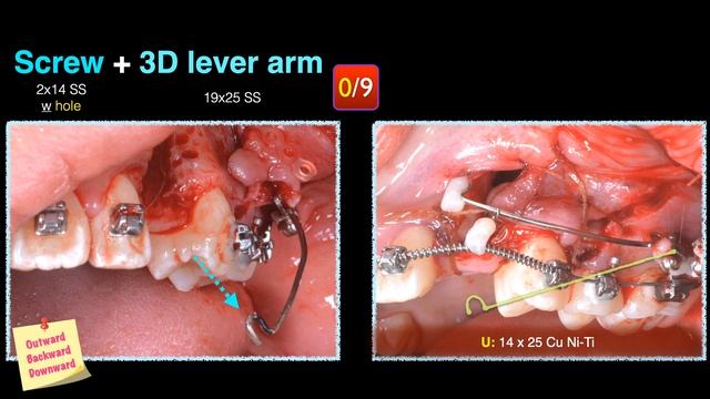 Solving Trans-alveolar impaction with 3D lever arm & screw｜【Chris Chang Ortho】CC685