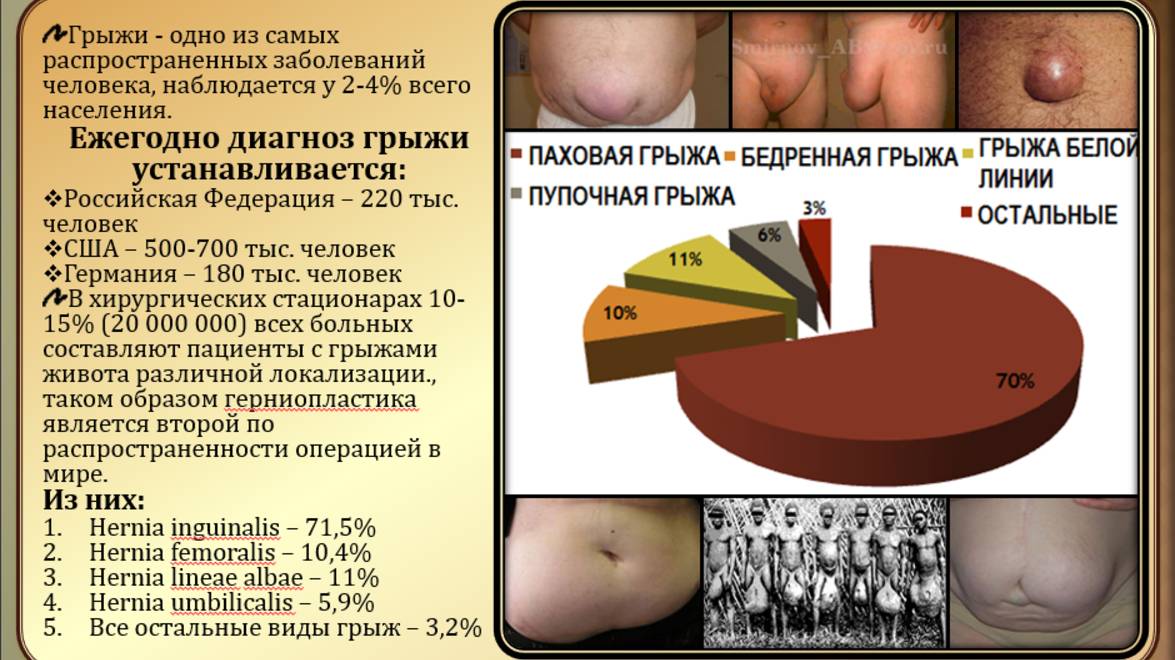 Грыжи живота - операции на грыжах