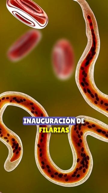 ELEFANTIASIS  | FILARIASIS #infecciones #filariasis