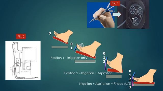 Basics of Phaco -  Part I (for Part II https://www.youtube.com/watch?v=UY6ZdPKPaJ4)  quickguide.org