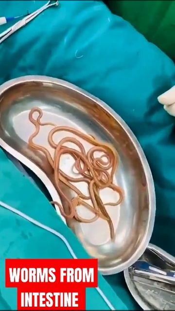 Worms Removed From Intestine #worms #ascari #pinworm #ascaris #surgeon