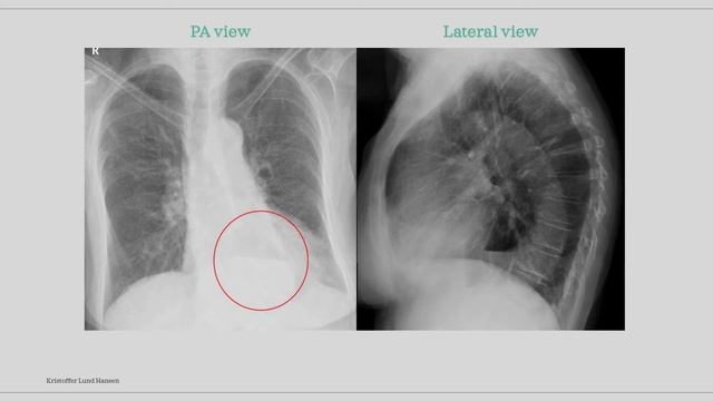 Chest X-ray cases 1 - with explanation