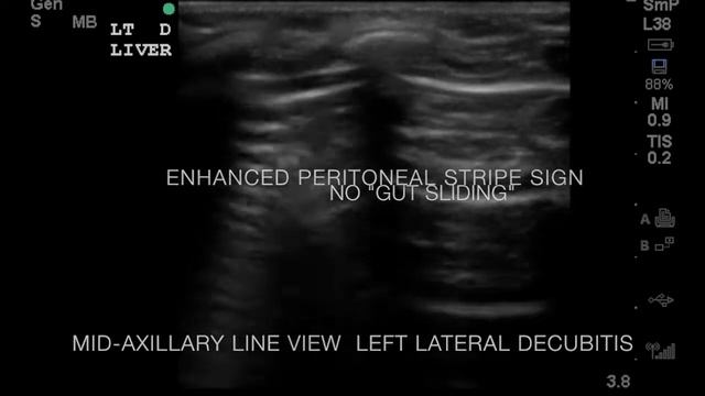 Pneumoperitoneum betw Liver and Abd Wall in Lt Lat Decubitis