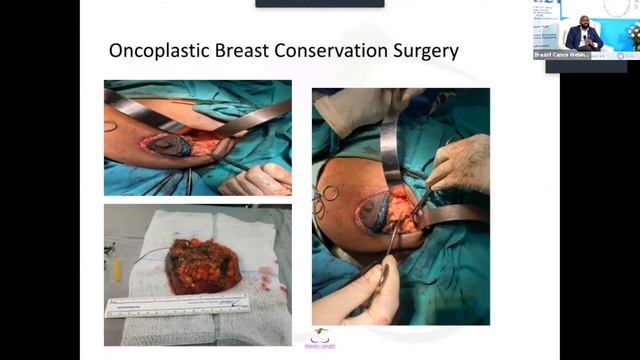 Advances in Breast Cancer Surgery (Webinar 1)