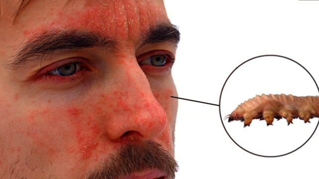 demodex mites lay eggs on your face damages caused by demodex creepy worms crawling on skin