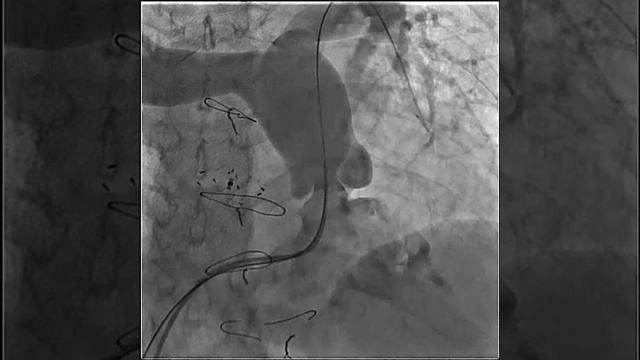 Vol.3 Issue 4 - Video 3A: Continuous Assessment of a Stented Coronary Artery...