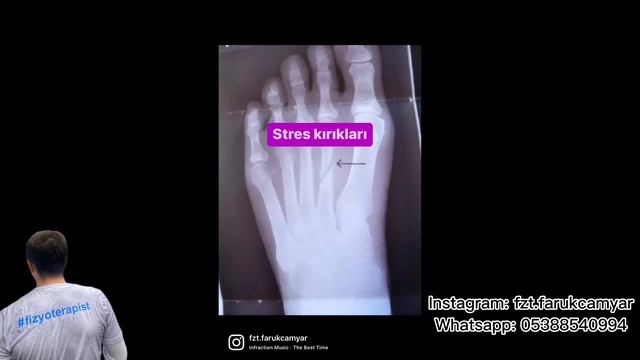 Yüksek topuklu ayakkabı giymenin sakıncaları
