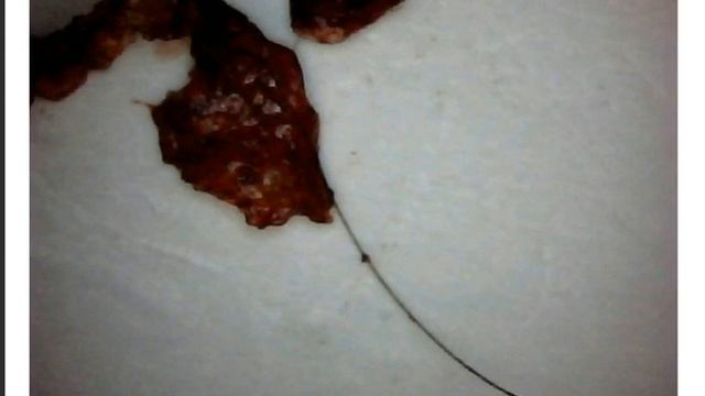 Morgellons Disease morph Aspergillus Fumigatus & V Fend Vs Noxafil Pro   Shingle, Lyme Disease, Fib