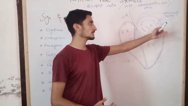 Mitral Valve Stenosis in Urdu/Causes/Sign and symptoms/Diagnosis/Treatment