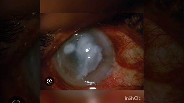 FUNGI - LECTURE 3 DEEP MYCOSIS, CANDIDIASIS, OPPORTUNISTIC INFECTIONS, MYCOTIC POISONING
