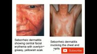 Eczema Homoeopathy medicine
treatment – causes, symptoms & homeopathy medicine
/ Fungal infection