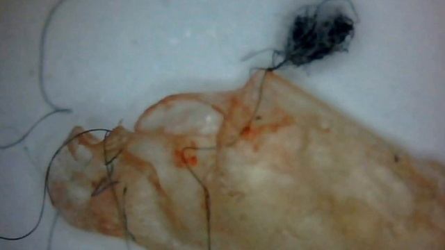How I Got Morgellons Disease? Morgellons Is Aspergillus Fumigatus Invasive Fungi & Highly Contagiou