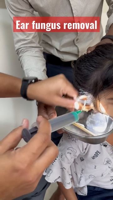 Ear fungus removal