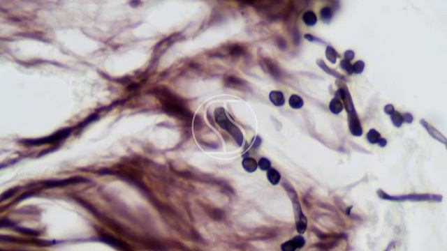Candida albicans under the microscope with Gomori's Methenamine Silver (GMS) stain
