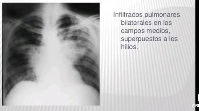 Micosis pulmonar 2