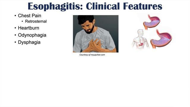 Esophagitis (Esophagus Inflammation): Causes, Risk Factors, Signs And Symptoms, Diagnosis, Treatmen