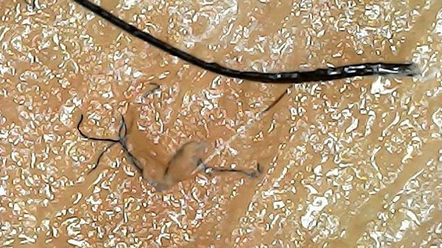 Aspergillus Fumigatus - Morgellons Disease The Silent Pandemic - skin disease, eczema, Lyme Disease